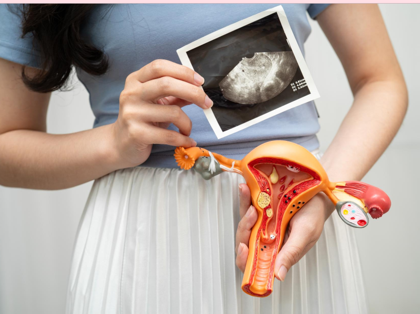 Endometriosis: Cuando el dolor menstrual esconde algo más